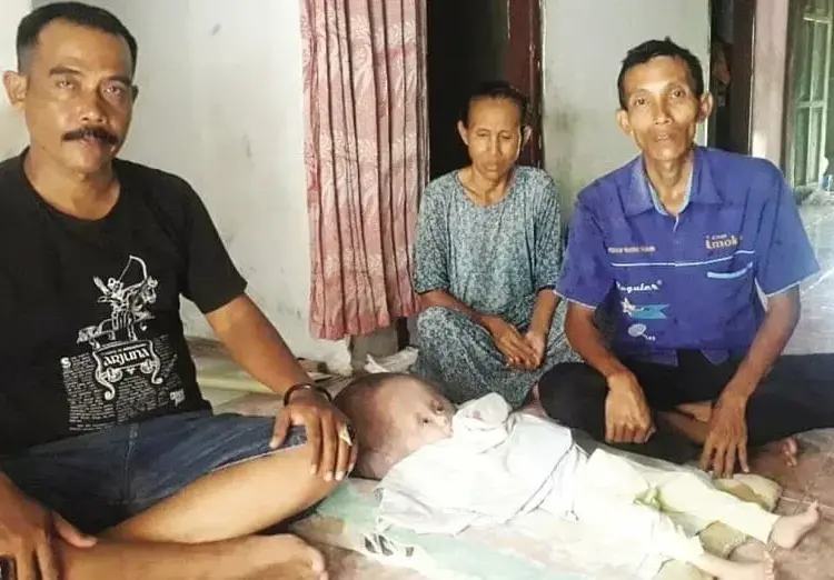 Bayi Mengidap Hidrosefalus, Butuhkan Bantuan